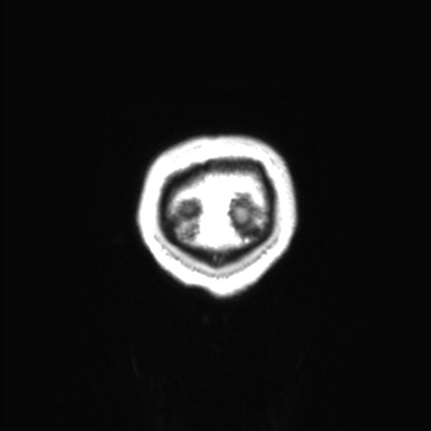 Callosal dysgenesis with interhemispheric cyst (Radiopaedia 53355-59335 Coronal T1 2).jpg