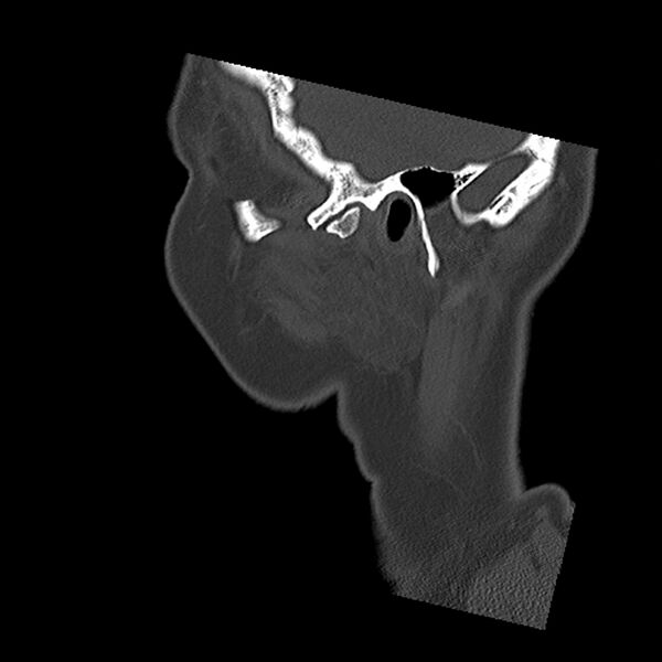 File:Canal up mastoidectomy (Radiopaedia 78108-90638 Sagittal bone window 8).jpg