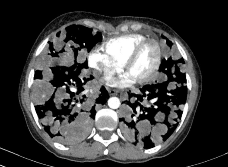 File:Cannonball metastases from breast cancer (Radiopaedia 91024-108569 A 84).jpg