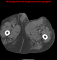 Cardiac perforation following transcatheter aortic valve implantation (Radiopaedia 23714-23863 B 26).png
