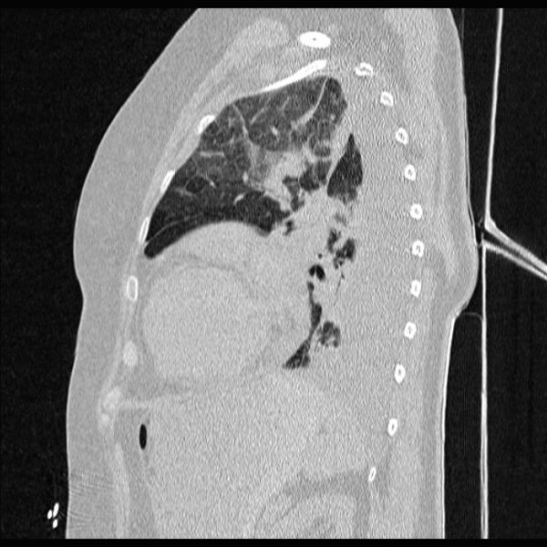 File:Cardiogenic pulmonary edema (Radiopaedia 29213-29609 Sagittal lung window 69).jpg