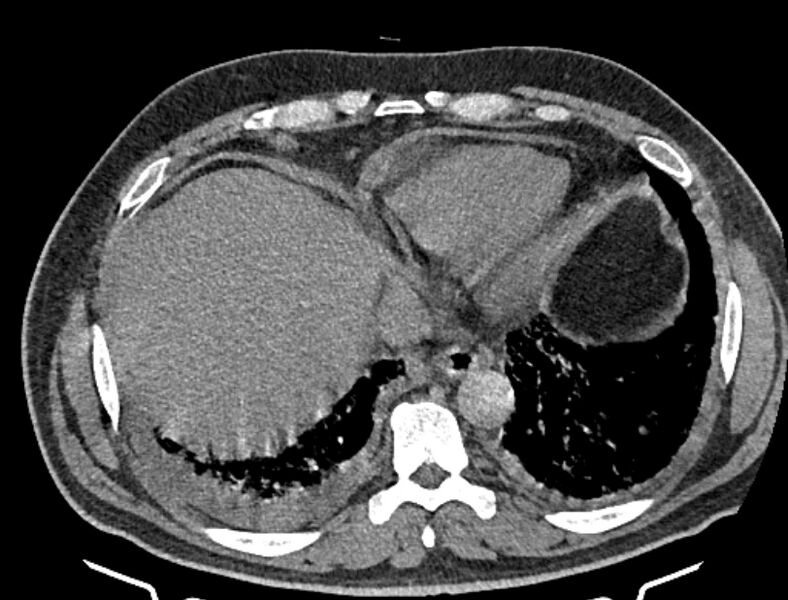 File:Cardiogenic pulmonary edema (Radiopaedia 68180-77678 Axial non-contrast 43).jpg
