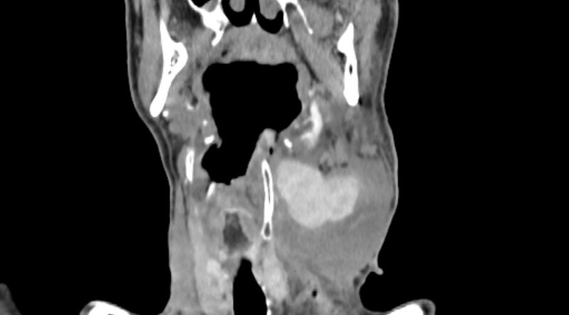 File:Carotid artery pseudoaneurysm (Radiopaedia 84030-99259 D 38).jpg