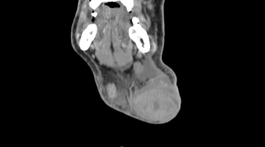Carotid artery pseudoaneurysm (Radiopaedia 84030-99259 D 6).jpg