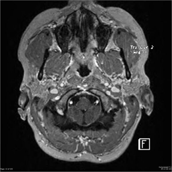File:Cavernous malformation (cavernous angioma or cavernoma) (Radiopaedia 36675-38237 Axial T1 C+ 6).jpg
