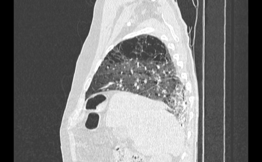 Cavitating bronchogenic carcinoma (Radiopaedia 44489-48162 Sagittal lung window 10).jpg