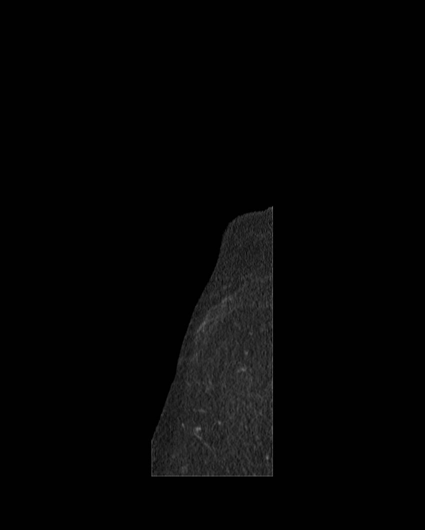 Cecal volvulus (Radiopaedia 54998-61310 C 3).jpg
