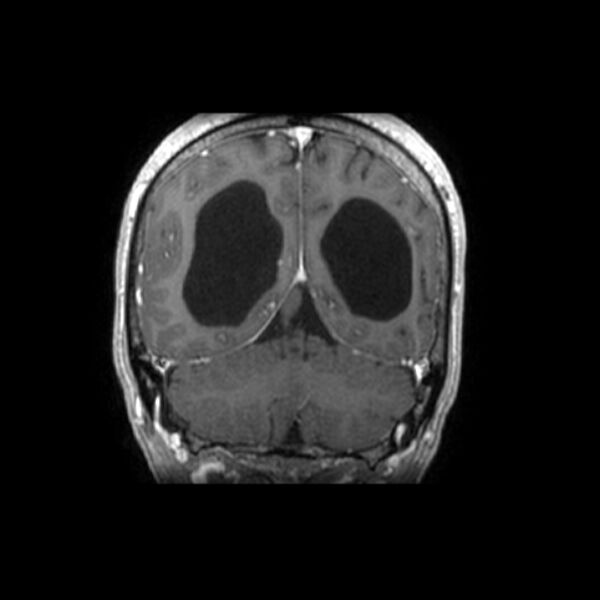 File:Central neurocytoma (Radiopaedia 67618-77021 Coronal T1 C+ 7).jpg