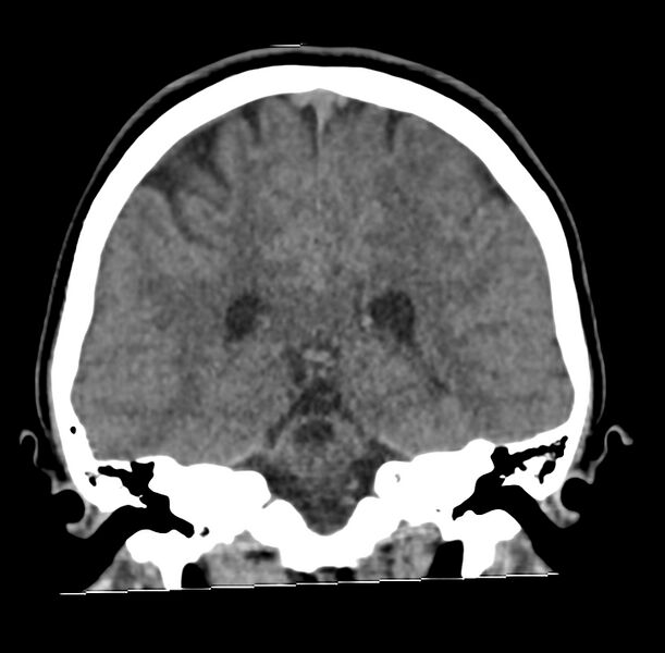 File:Cerebellar agenesis (Radiopaedia 30203-30817 Coronal non-contrast 26).jpg
