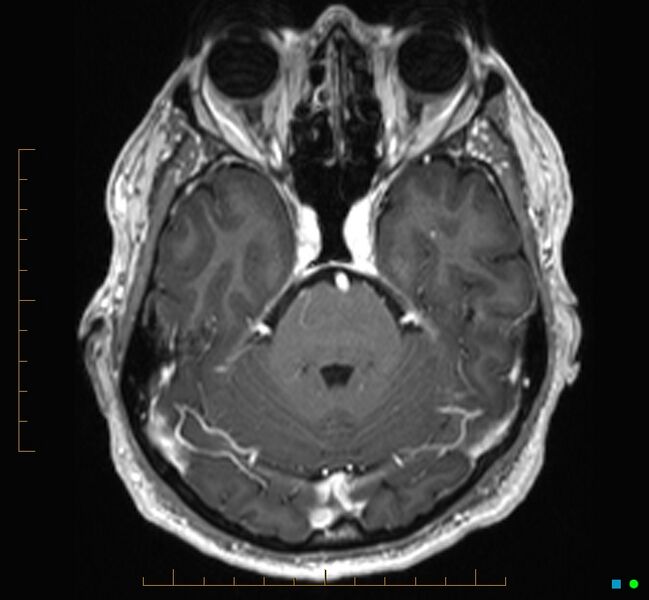 File:Cerebellar gangliocytoma (Radiopaedia 65377-74422 Axial T1 C+ 35).jpg