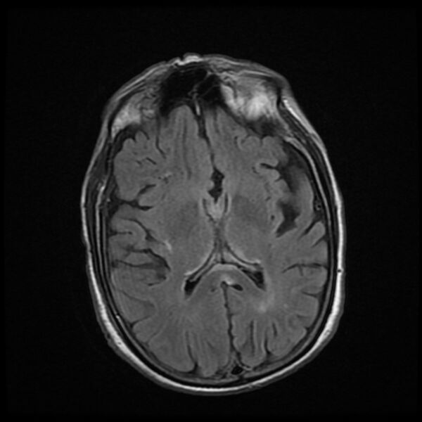 File:Cerebellar metastasis - lung tumor (Radiopaedia 69317-79147 Axial FLAIR 9).jpg