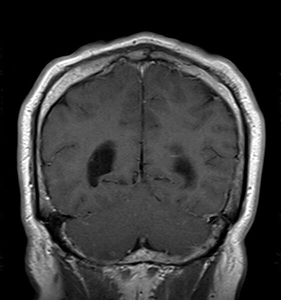 File:Cerebellopontine angle meningioma (Radiopaedia 24459-24764 Coronal T1 C+ 19).jpg
