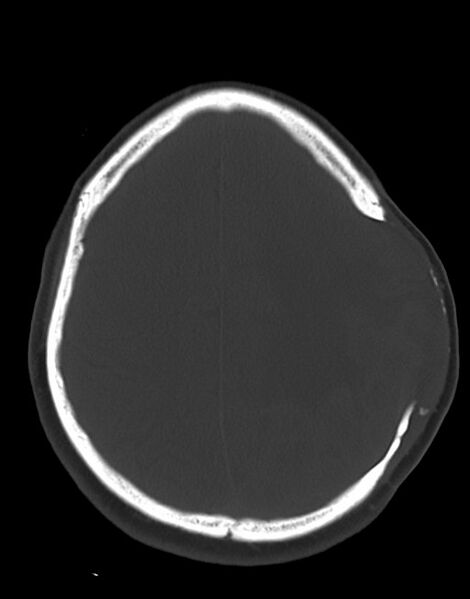 File:Cerebral abscesses (Radiopaedia 70458-80568 Axial bone window 45).jpg