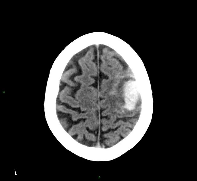 File:Cerebral amyloid angiopathy-associated lobar intracerebral hemorrhage (Radiopaedia 58376-65511 Axial non-contrast 14).jpg