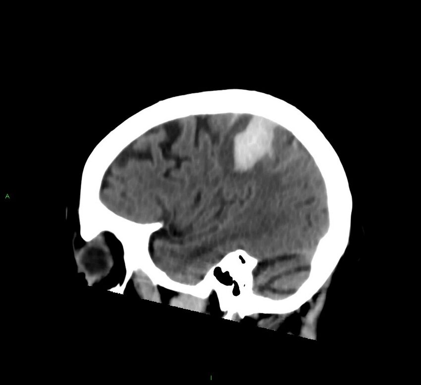 Cerebral amyloid angiopathy-associated lobar intracerebral hemorrhage (Radiopaedia 58376-65513 C 24).jpg