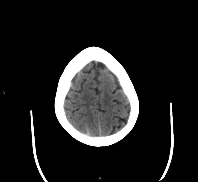 File:Cerebral amyloid angiopathy-associated lobar intracerebral hemorrhage (Radiopaedia 58377-65514 Axial non-contrast 10).jpg