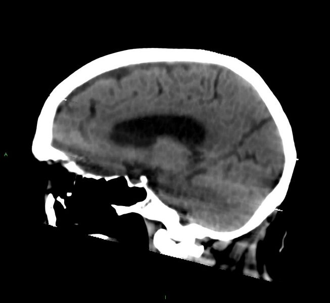 File:Cerebral amyloid angiopathy-associated lobar intracerebral hemorrhage (Radiopaedia 58377-65514 B 28).jpg