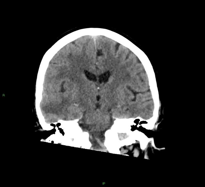 File:Cerebral amyloid angiopathy-associated lobar intracerebral hemorrhage (Radiopaedia 58378-65516 Coronal non-contrast 32).jpg