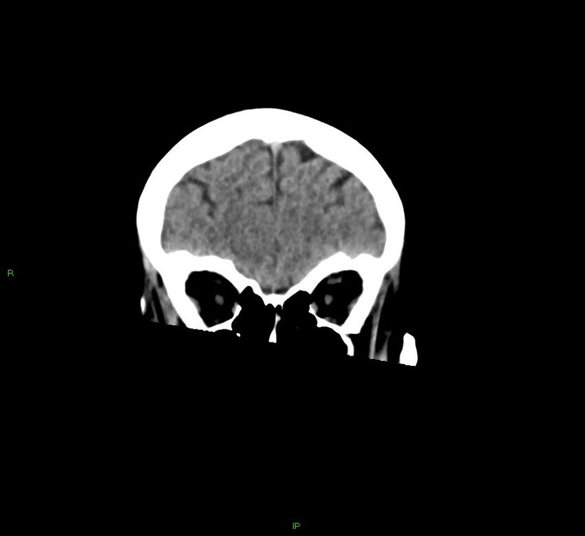 Cerebral amyloid angiopathy-associated lobar intracerebral hemorrhage (Radiopaedia 58378-65516 Coronal non-contrast 49).jpg