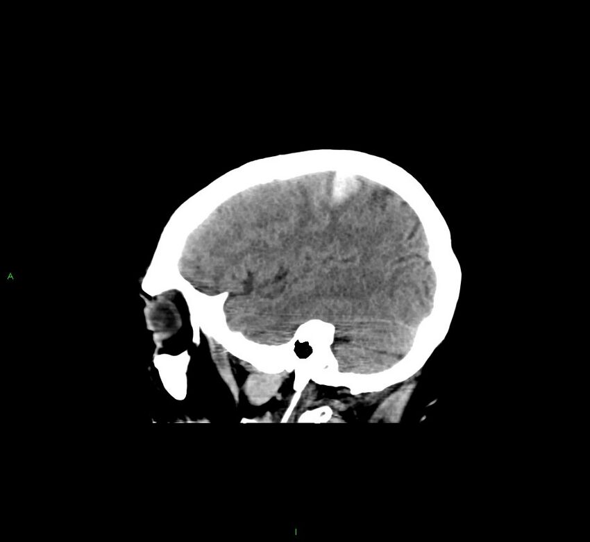 Cerebral amyloid angiopathy-associated lobar intracerebral hemorrhage (Radiopaedia 58529-65681 B 38).jpg