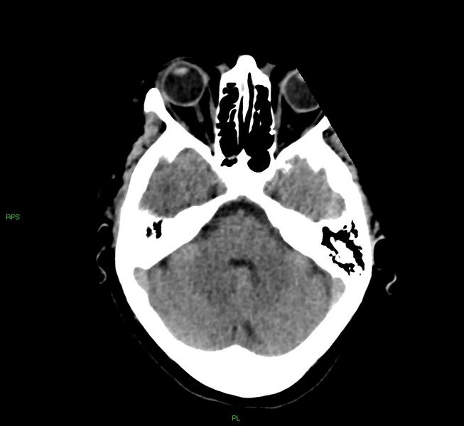 File:Cerebral amyloid angiopathy-associated lobar intracerebral hemorrhage (Radiopaedia 58569-65734 Axial non-contrast 44).jpg