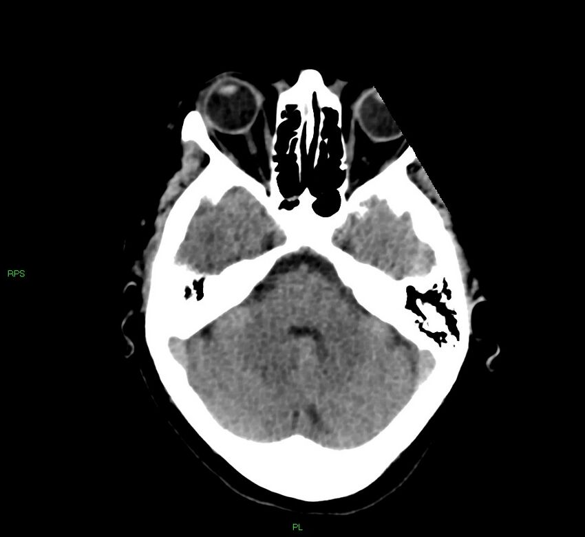 Cerebral amyloid angiopathy-associated lobar intracerebral hemorrhage (Radiopaedia 58569-65734 Axial non-contrast 44).jpg