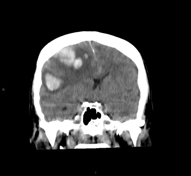 File:Cerebral amyloid angiopathy-associated lobar intracerebral hemorrhage (Radiopaedia 58756-65977 Coronal non-contrast 39).jpg