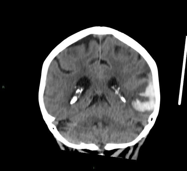File:Cerebral amyloid angiopathy-associated lobar intracerebral hemorrhage (Radiopaedia 58757-65978 Coronal non-contrast 25).jpg