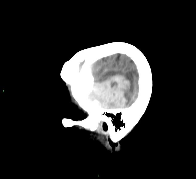 File:Cerebral amyloid angiopathy-associated lobar intracerebral hemorrhage (Radiopaedia 58758-65980 C 8).jpg