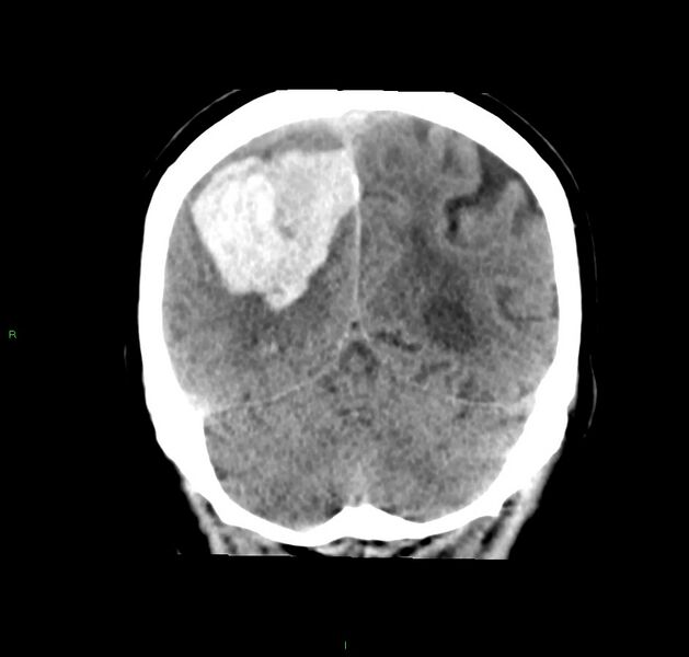 File:Cerebral amyloid angiopathy-associated lobar intracerebral hemorrhage (Radiopaedia 59356-66716 Coronal non-contrast 20).jpg