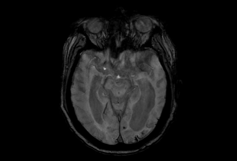 File:Cerebral amyloid angiopathy (Radiopaedia 86671-102792 Axial Gradient Echo 34).jpg