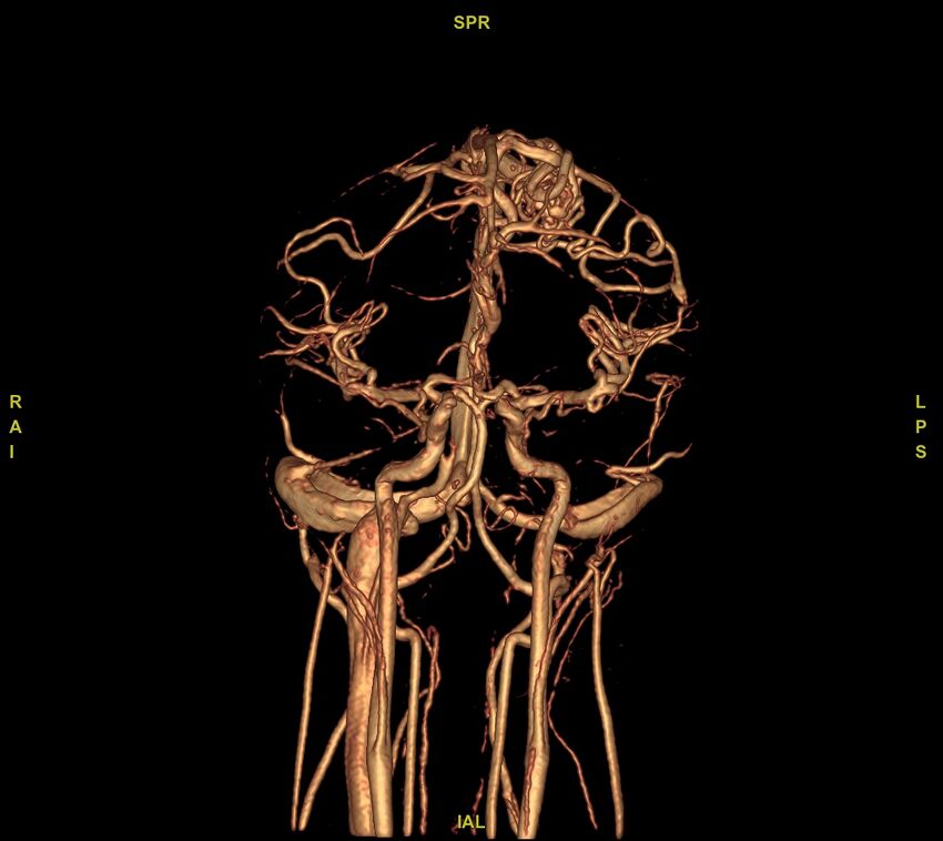 Cerebral arteriovenous malformation (Radiopaedia 61964-70029 VRT 40).jpg