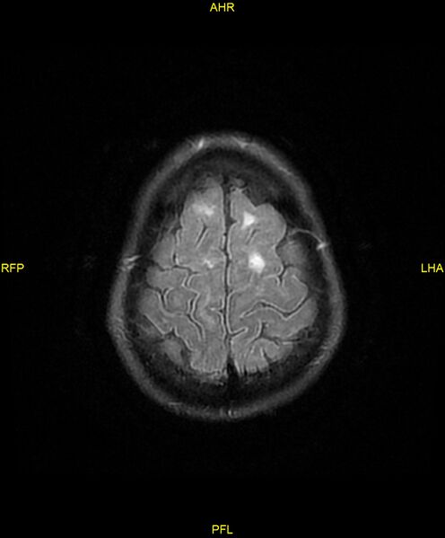 File:Cerebral autosomal dominant arteriopathy with subcortical infarcts and leukoencephalopathy (CADASIL) (Radiopaedia 86108-102054 Axial FLAIR 26).jpg