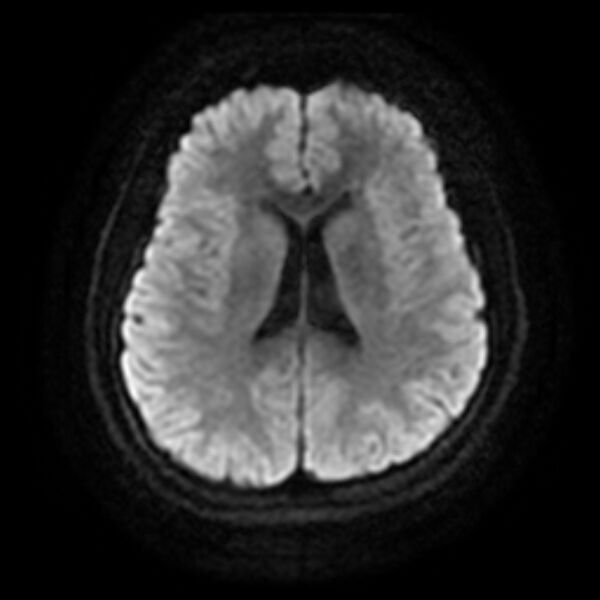 File:Cerebral cavernous malformation (Radiopaedia 44301-47942 Axial DWI 13).jpg