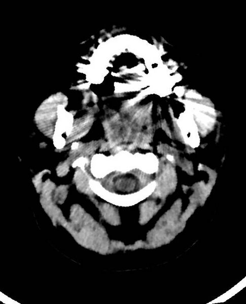 File:Cerebral edema due to severe hyponatremia (Radiopaedia 89826-106938 Axial non-contrast 2).jpg