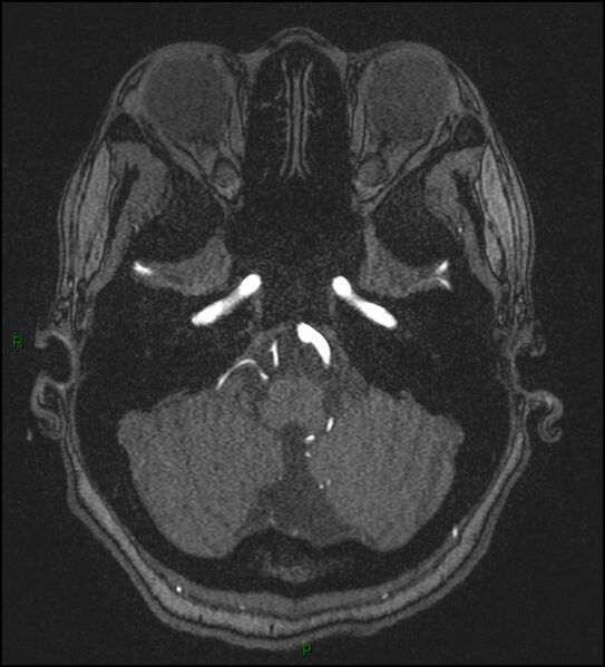 File:Cerebral fat embolism (Radiopaedia 35022-36525 Axial TOF 35).jpg
