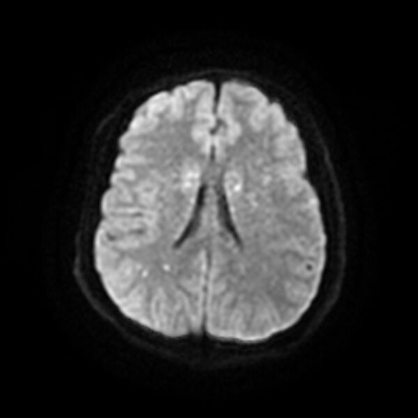 File:Cerebral fat embolism (Radiopaedia 37510-39363 Axial DWI 17).jpg