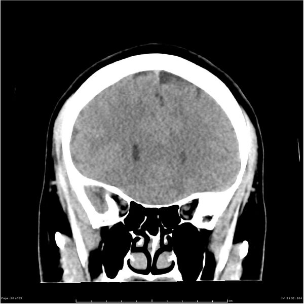File:Cerebral hemorrhage secondary to arteriovenous malformation (Radiopaedia 33497-34561 Coronal non-contrast 11).jpg