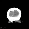 Cerebral hemorrhagic contusion with subdural and subarachnoid hemorrhage (Radiopaedia 10680-11146 Coronal non-contrast 18).jpg