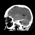 Cerebral hemorrhagic contusions (Radiopaedia 23145-23188 C 15).jpg