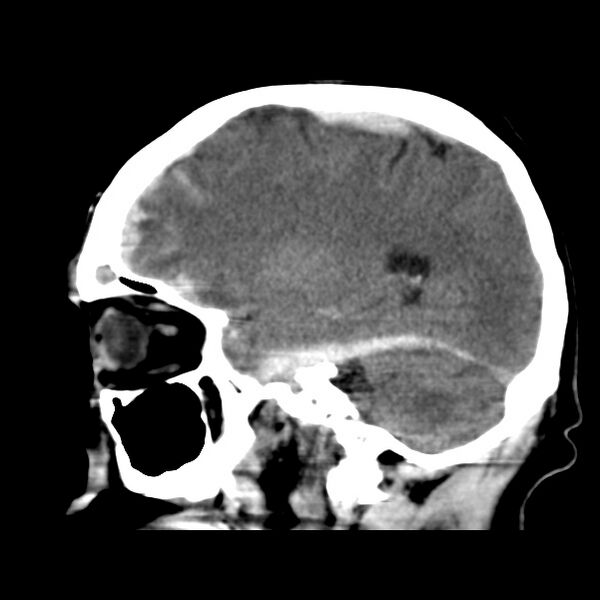 File:Cerebral hemorrhagic contusions (Radiopaedia 23145-23188 C 15).jpg