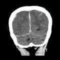 Cerebral hemorrhagic contusions (Radiopaedia 23145-23188 Coronal non-contrast 35).jpg
