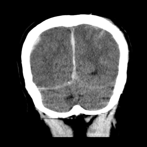 File:Cerebral hemorrhagic contusions (Radiopaedia 23145-23188 Coronal non-contrast 35).jpg