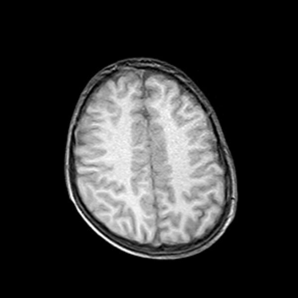 File:Cerebral tuberculoma (Radiopaedia 41152-43932 Axial T1 17).jpg