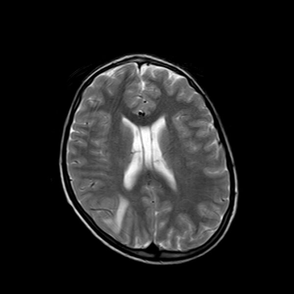 File:Cerebral tuberculoma (Radiopaedia 41152-43932 Axial T2 14).jpg