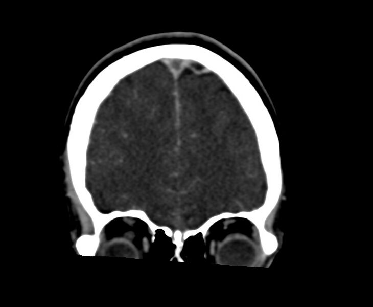 File:Cerebral venous sinus thrombosis (Radiopaedia 59224-66646 Coronal C+ delayed 13).jpg