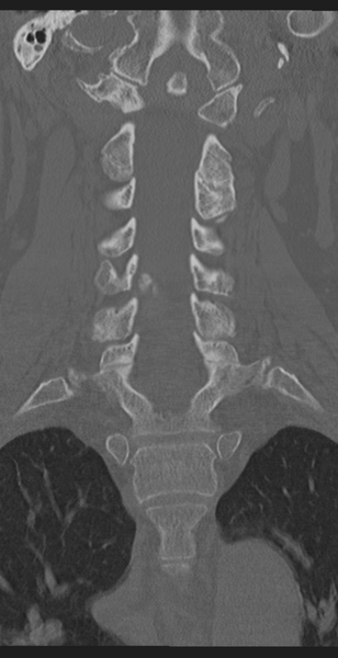 File:Cervical canal stenosis - OPLL and osteophytes (Radiopaedia 47329-51910 Coronal bone window 29).png