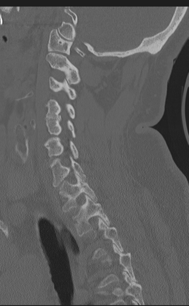 File:Cervical canal stenosis - OPLL and osteophytes (Radiopaedia 47329-51910 Sagittal bone window 48).png