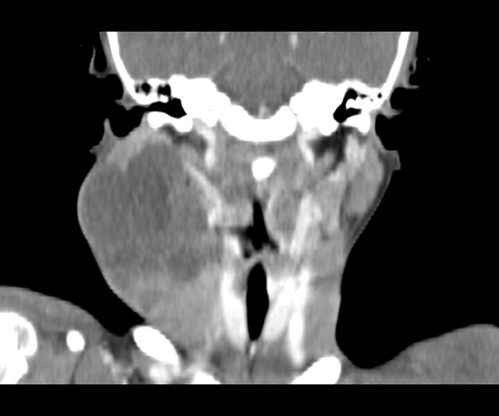 File:Cervical cystic lymphangioma (Radiopaedia 63655-72332 Coronal + contrast 21).jpg