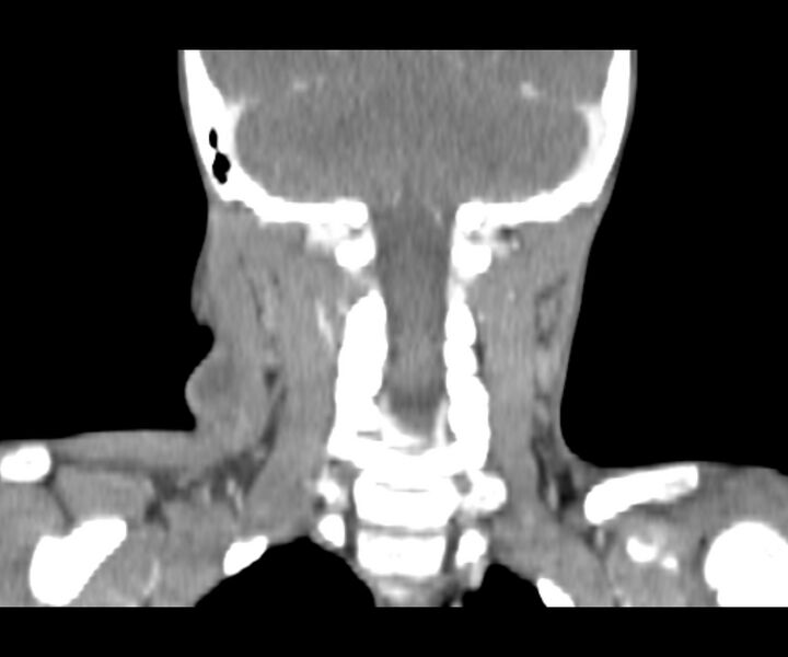 File:Cervical cystic lymphangioma (Radiopaedia 63655-72332 Coronal + contrast 26).jpg